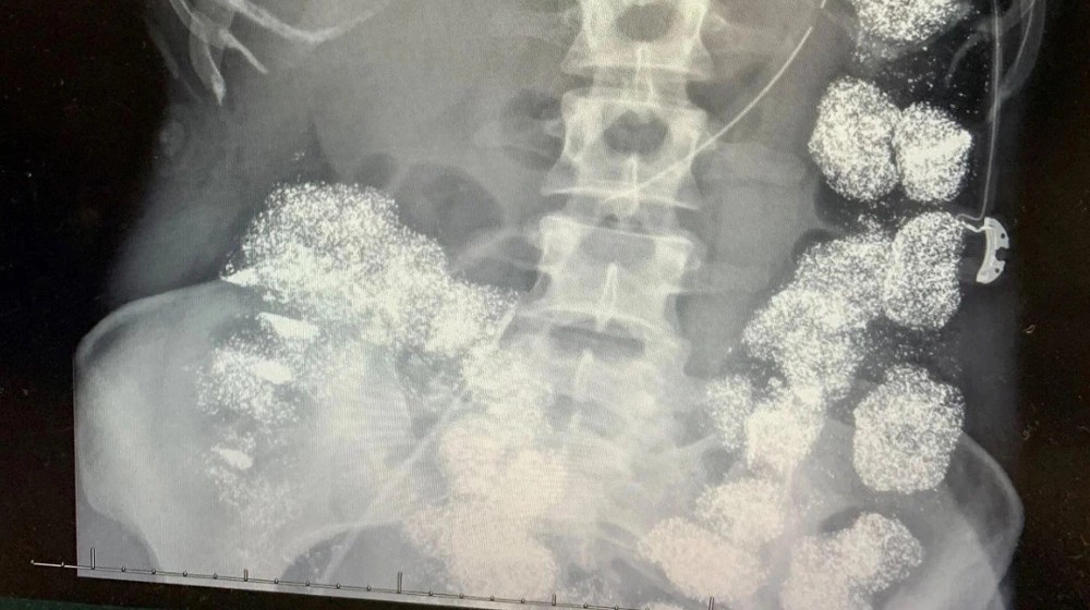 &Acirc;m Mưu Trục Lợi Bảo Hiểm: Khi B&aacute;c Sĩ D&ugrave;ng Ch&igrave; Đầu Độc Vợ V&agrave; C&aacute;i Gi&aacute; Phải Trả - Ảnh 3